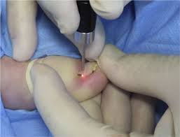 Laser Matricectomy